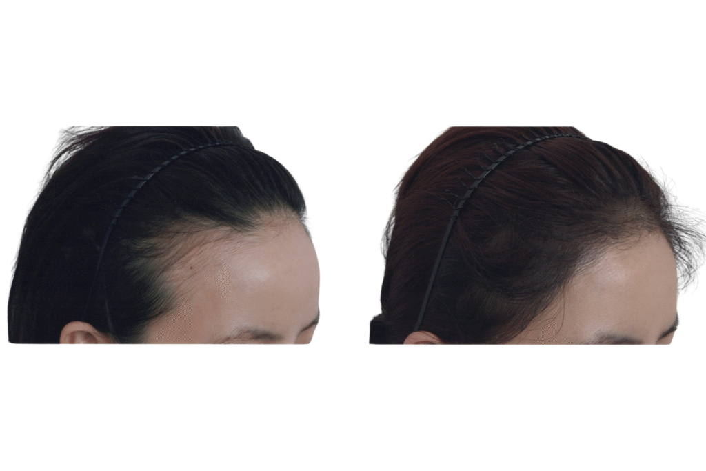 hairline (6)